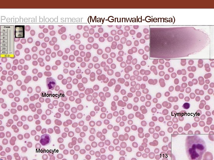 Peripheral blood smear (May-Grunwald-Giemsa) Monocyte Lymphocyte Monocyte 113 