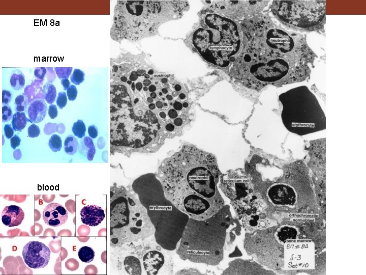 EM 8 a marrow blood 