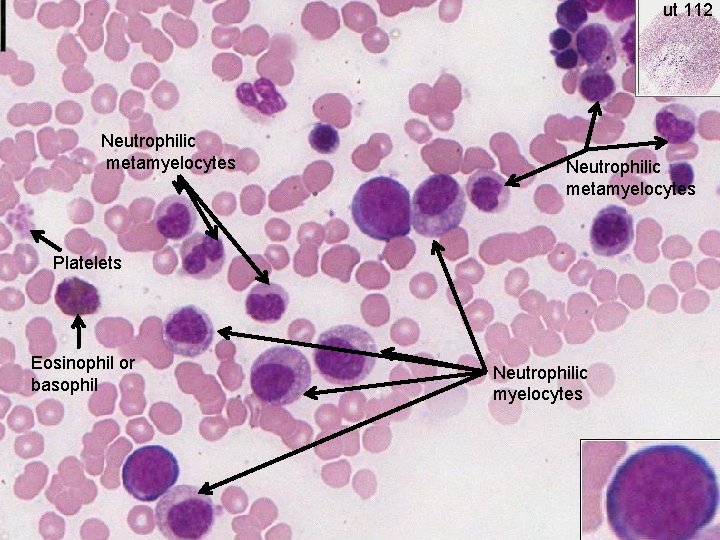 ut 112 Neutrophilic metamyelocytes Platelets Eosinophil or basophil Neutrophilic myelocytes 