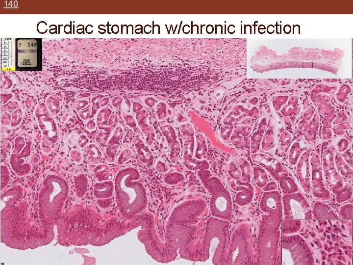 140 Cardiac stomach w/chronic infection 