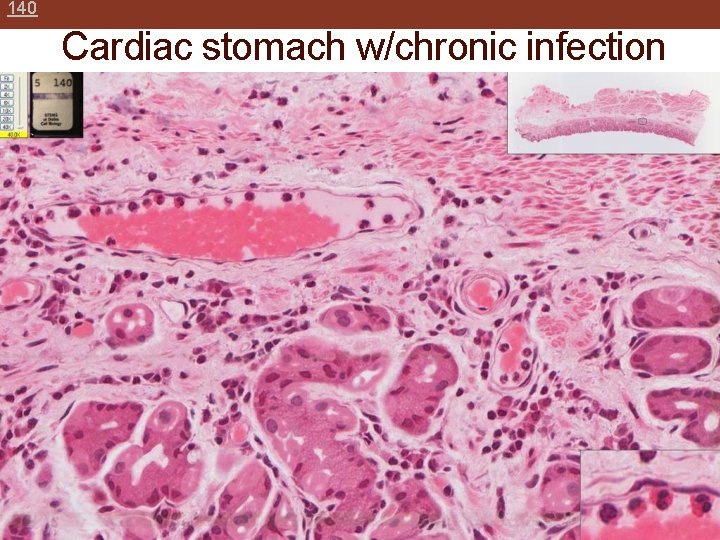 140 Cardiac stomach w/chronic infection 