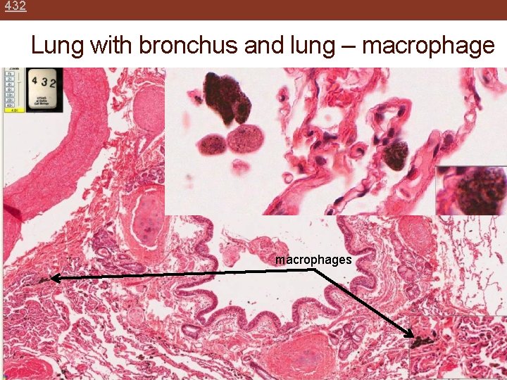 432 Lung with bronchus and lung – macrophages 