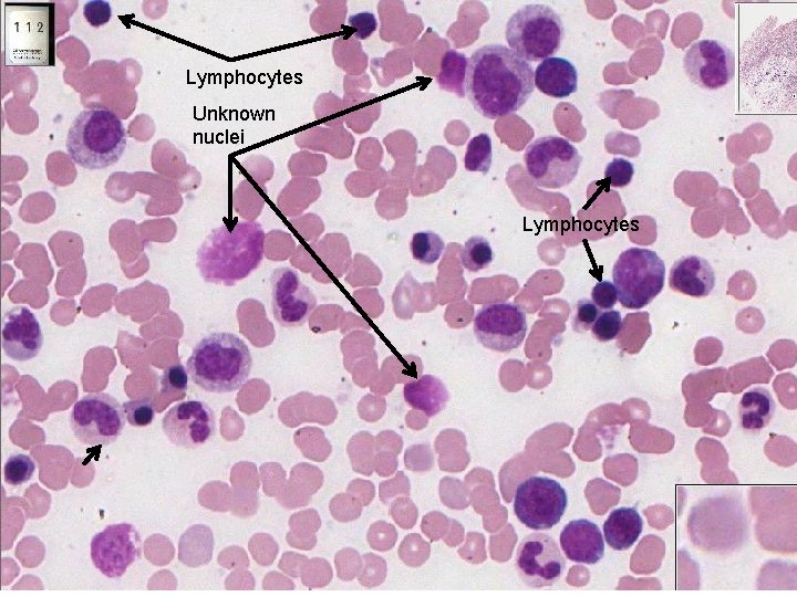 Lymphocytes Unknown nuclei Lymphocytes 