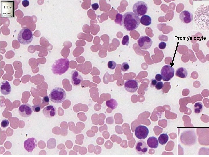 Promyelocyte 