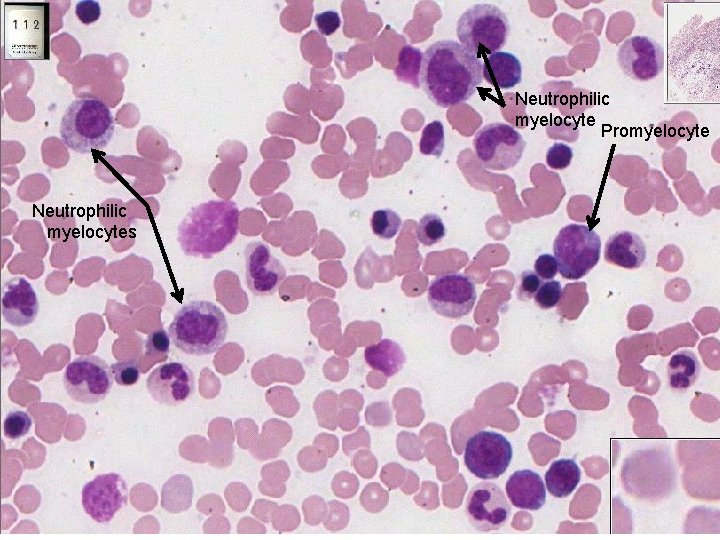 Neutrophilic myelocyte Promyelocyte Neutrophilic myelocytes 