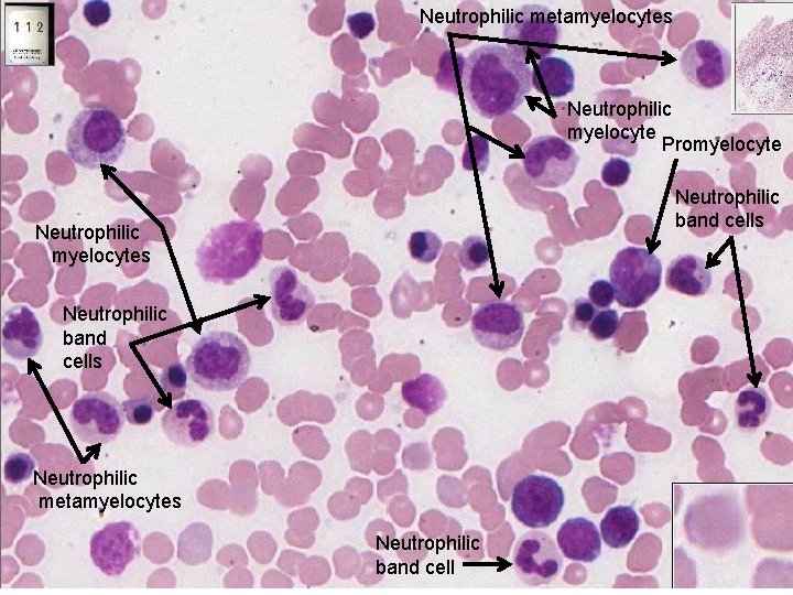 Neutrophilic metamyelocytes Neutrophilic myelocyte Promyelocyte Neutrophilic band cells Neutrophilic myelocytes Neutrophilic band cells Neutrophilic