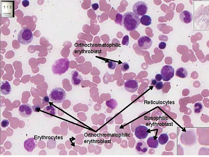 Orthochromatophilic erythroblast Reticulocytes Basophilic erythroblast Erythrocytes Orthochromatophilic erythroblast 