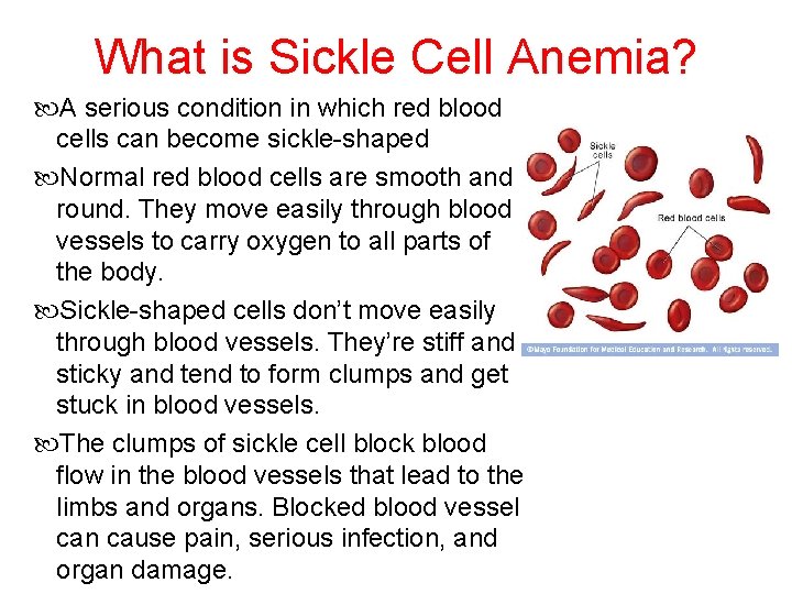 What is Sickle Cell Anemia? A serious condition in which red blood cells can
