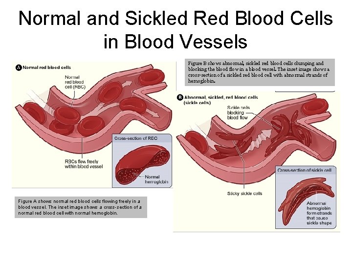 Normal and Sickled Red Blood Cells in Blood Vessels Figure B shows abnormal, sickled