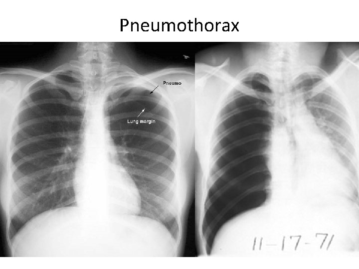 Pneumothorax 