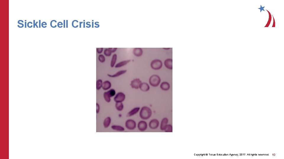 Sickle Cell Crisis Copyright © Texas Education Agency, 2017. All rights reserved. 10 