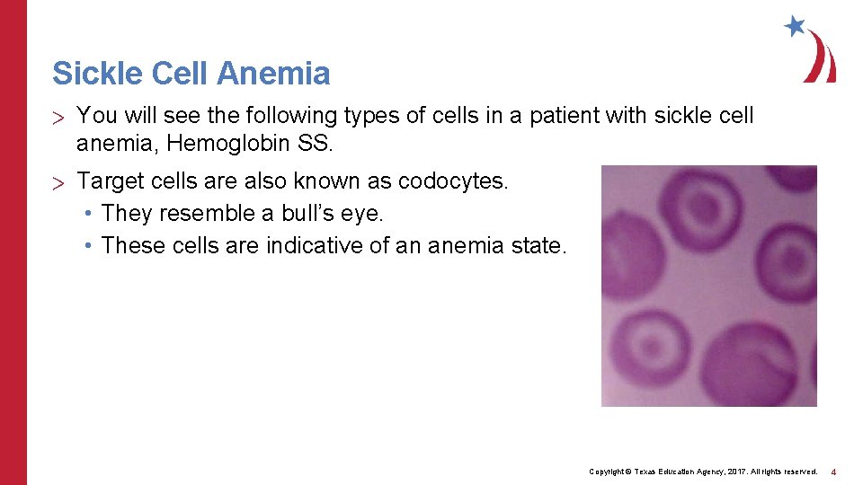 Sickle Cell Anemia > You will see the following types of cells in a