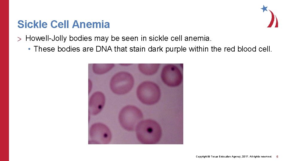 Sickle Cell Anemia > Howell-Jolly bodies may be seen in sickle cell anemia. •
