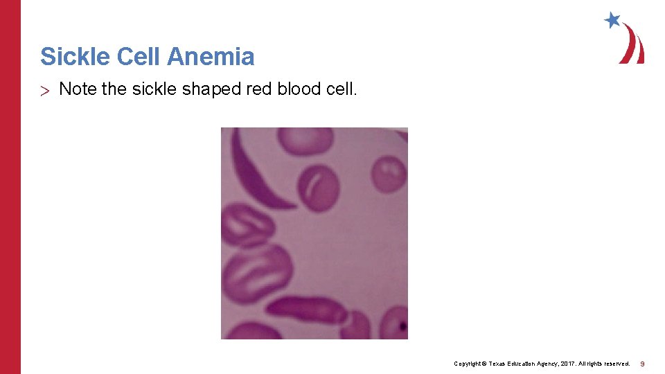 Sickle Cell Anemia > Note the sickle shaped red blood cell. Copyright © Texas