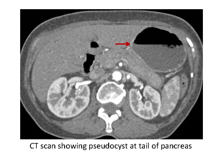 CT scan showing pseudocyst at tail of pancreas 