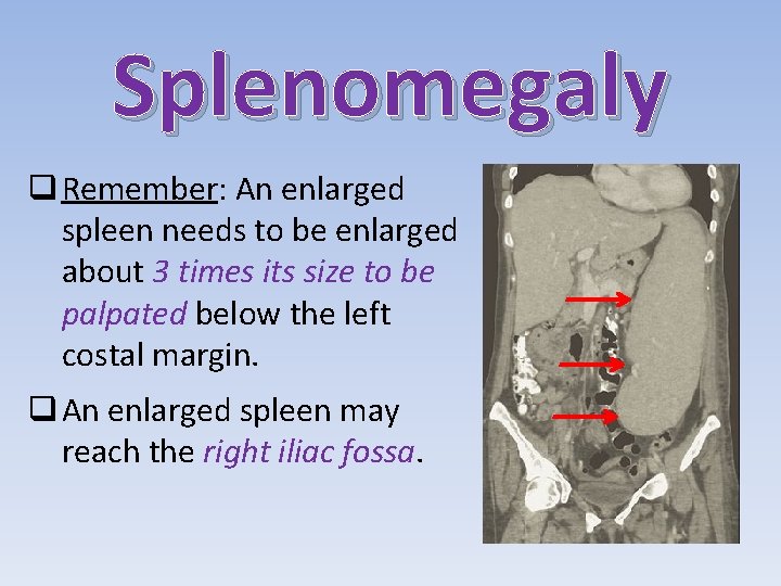 Splenomegaly q Remember: An enlarged spleen needs to be enlarged about 3 times its