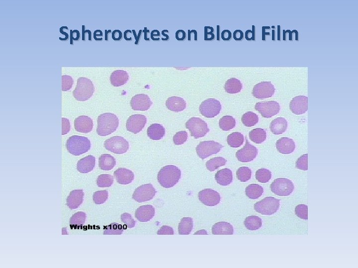Spherocytes on Blood Film 