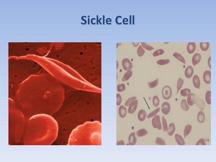 Sickle Cell 