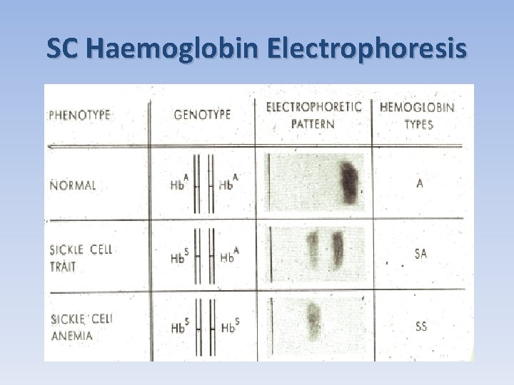 SC Haemoglobin Electrophoresis 