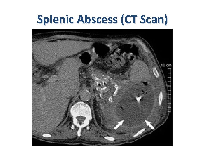 Splenic Abscess (CT Scan) 