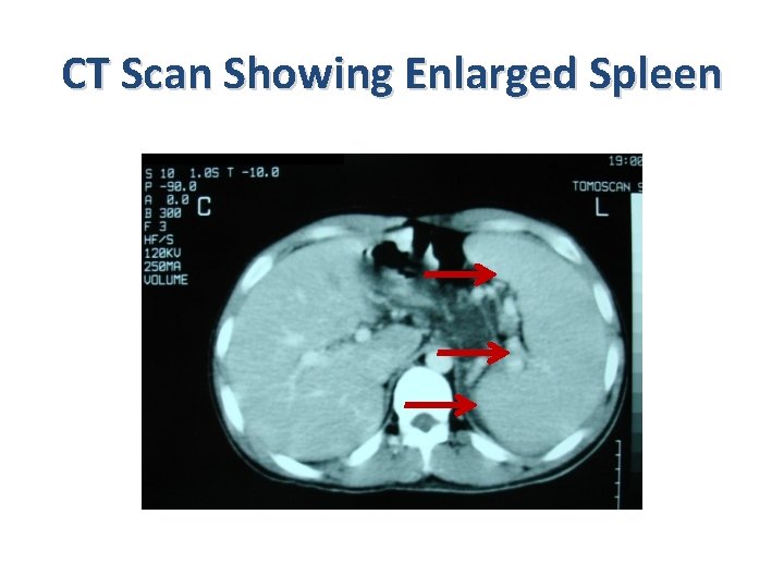 CT Scan Showing Enlarged Spleen 