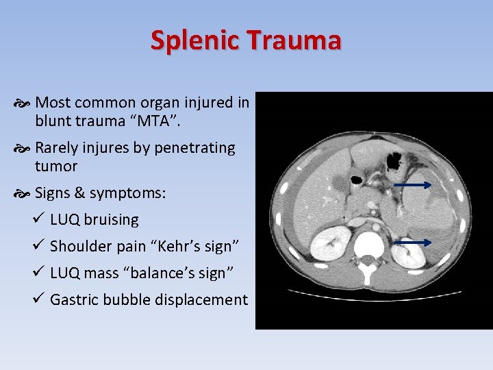 Splenic Trauma Most common organ injured in blunt trauma “MTA”. Rarely injures by penetrating