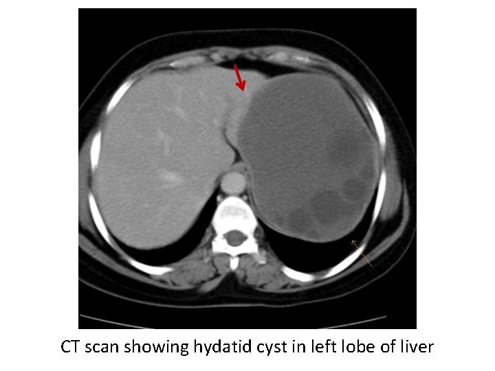 CT scan showing hydatid cyst in left lobe of liver 