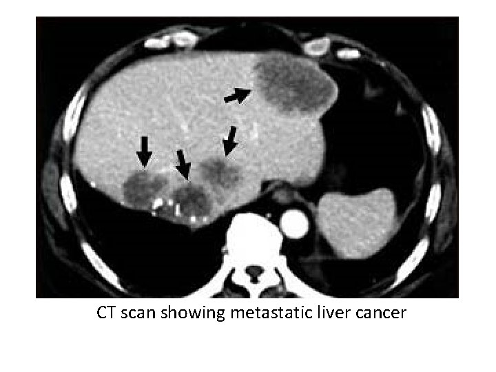 CT scan showing metastatic liver cancer 