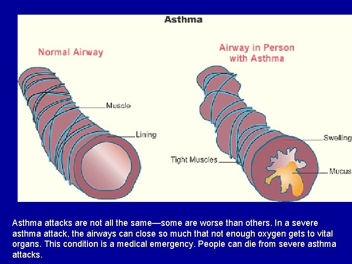 Asthma attacks are not all the same—some are worse than others. In a severe