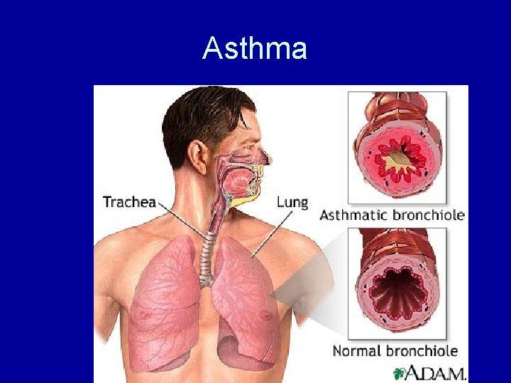 Asthma 