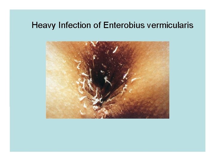 Heavy Infection of Enterobius vermicularis 