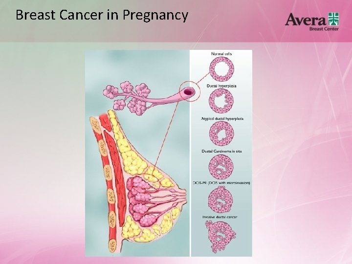 Breast Cancer in Pregnancy 