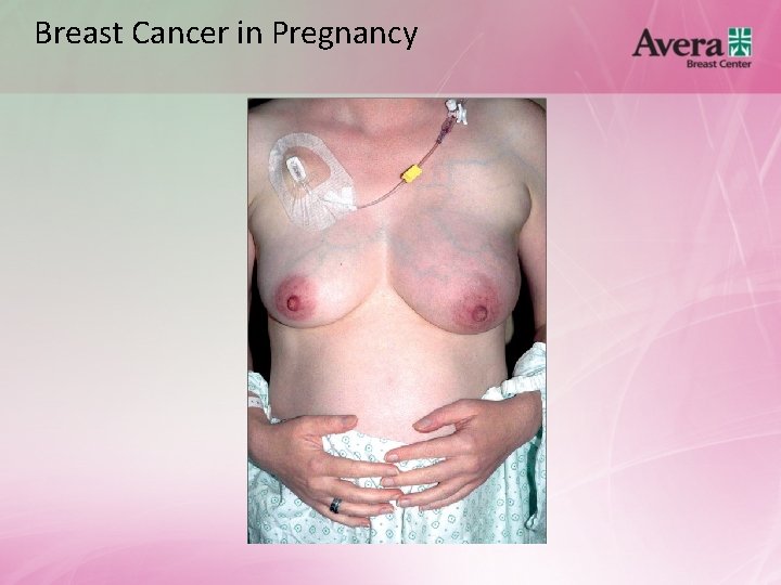 Breast Cancer in Pregnancy 