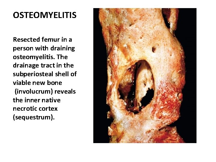 OSTEOMYELITIS Resected femur in a person with draining osteomyelitis. The drainage tract in the