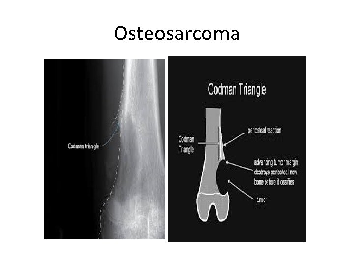 Osteosarcoma 