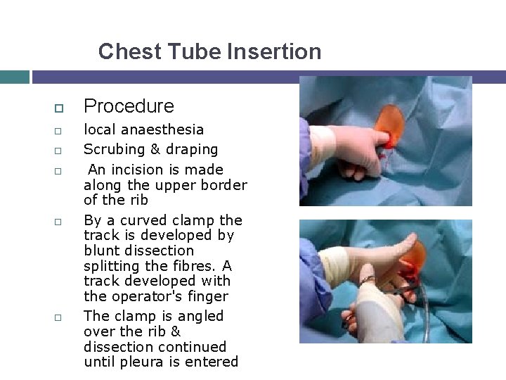 Chest Tube Insertion Procedure local anaesthesia Scrubing & draping An incision is made along