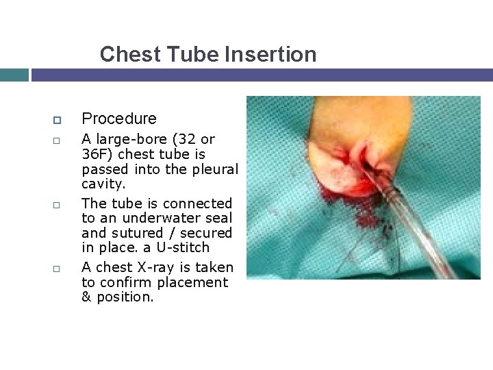 Chest Tube Insertion Procedure A large-bore (32 or 36 F) chest tube is passed