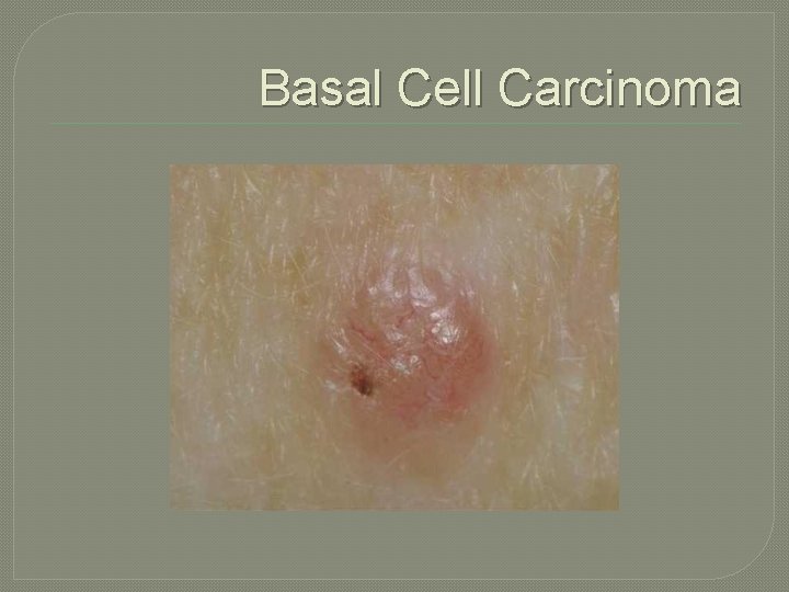 Basal Cell Carcinoma 