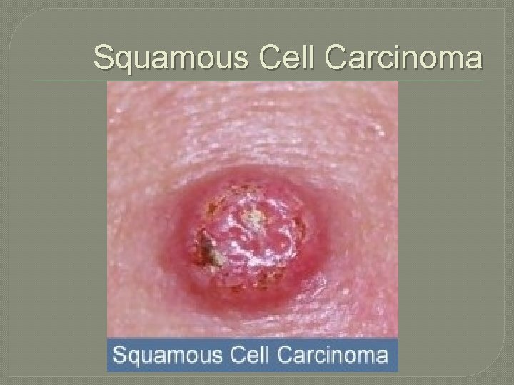 Squamous Cell Carcinoma 