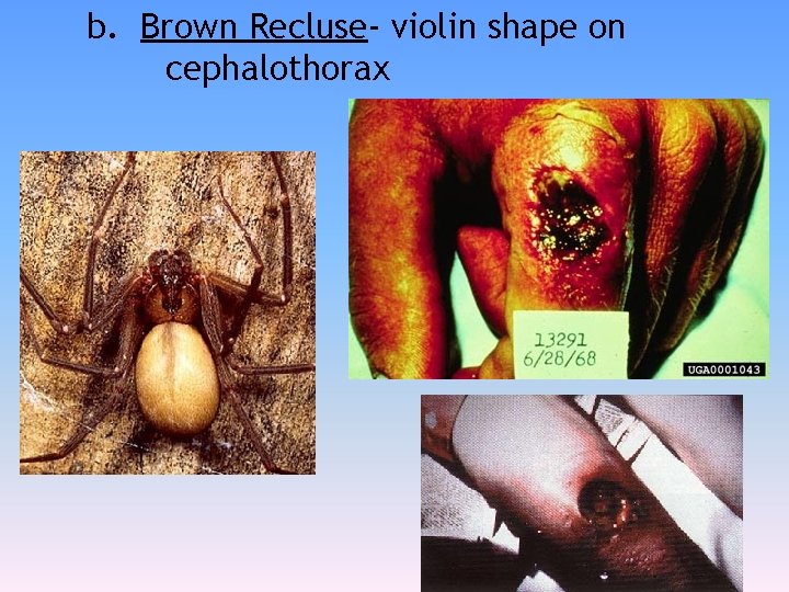 b. Brown Recluse- violin shape on cephalothorax 