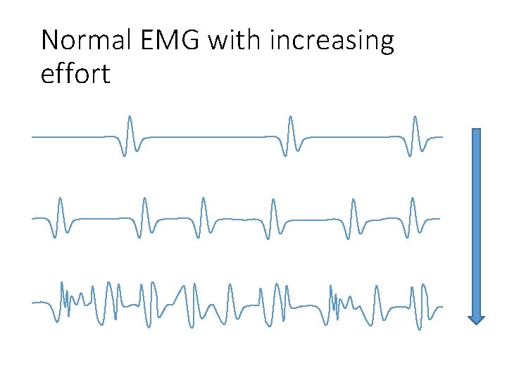 Normal EMG with increasing effort 