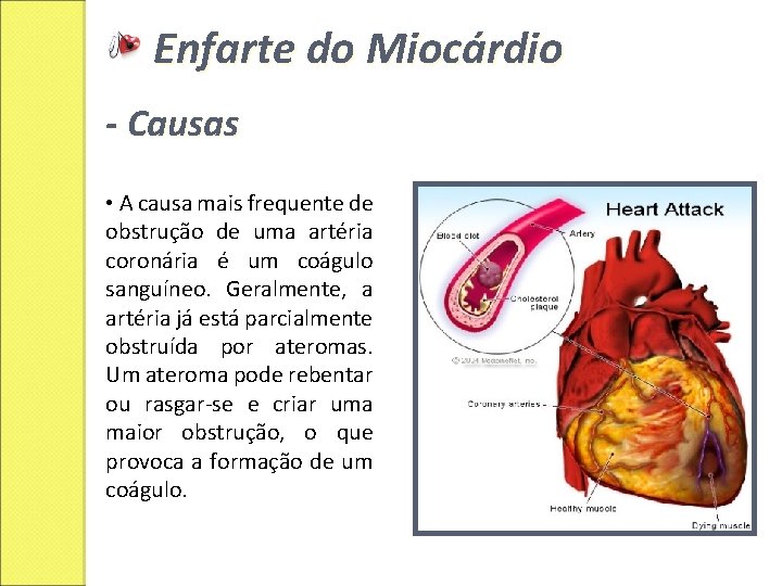 Enfarte do Miocárdio - Causas • A causa mais frequente de obstrução de uma