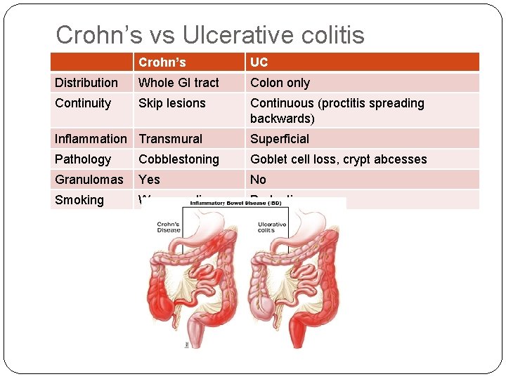 Crohn’s vs Ulcerative colitis Crohn’s UC Distribution Whole GI tract Colon only Continuity Skip
