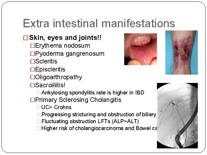 Extra intestinal manifestations � Skin, eyes and joints!! �Erythema nodosum �Pyoderma gangrenosum �Scleritis �Episcleritis