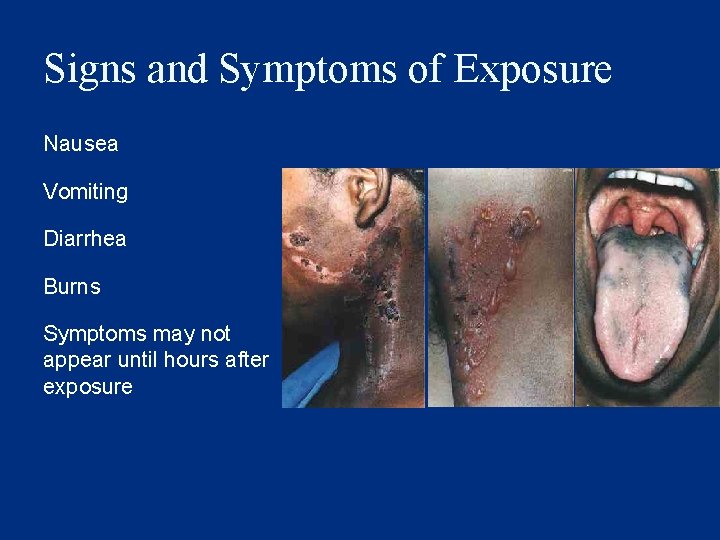 Signs and Symptoms of Exposure Nausea Vomiting Diarrhea Burns Symptoms may not appear until