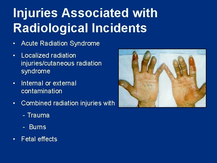 Injuries Associated with Radiological Incidents • Acute Radiation Syndrome • Localized radiation injuries/cutaneous radiation