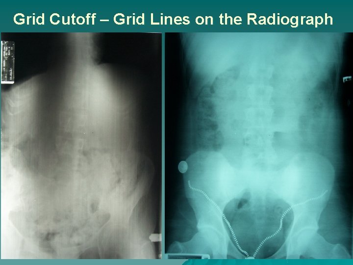 Grid Cutoff – Grid Lines on the Radiograph 