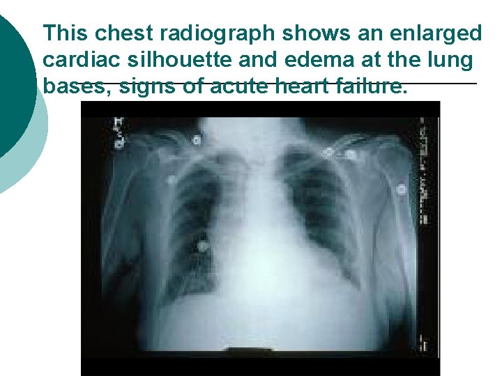 This chest radiograph shows an enlarged cardiac silhouette and edema at the lung bases,