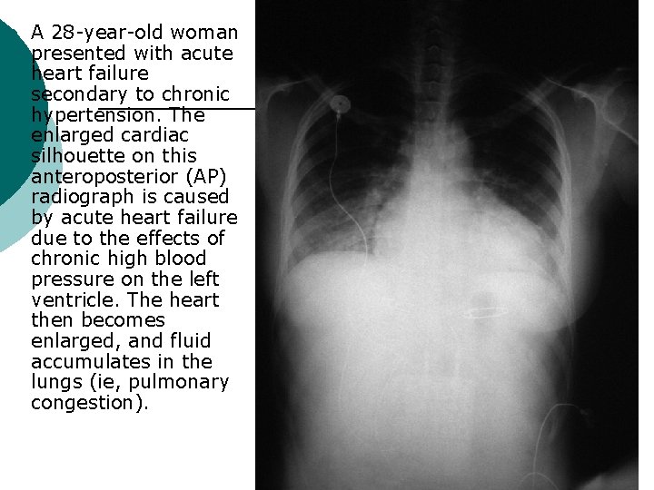 ¡ A 28 -year-old woman presented with acute heart failure secondary to chronic hypertension.