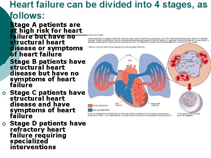 Heart failure can be divided into 4 stages, as follows: ¡ ¡ Stage A